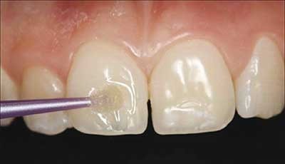 روشی جدید برای ترمیم مینای دندان